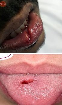 <p>most frequent type of soft tissue injury</p><p>a tear in the <span style="color: red;">epithelial and subepithelial</span> tissues</p><ul><li><p>commonly caused by a sharp object</p><ul><li><p>knife & luxator</p></li></ul></li><li><p>common sites:</p><ul><li><p>lips, tongue, gingiva</p></li><li><p>alveolar mucosa</p></li><li><p>floor of the mouth</p></li></ul></li><li><p><strong>key features:</strong></p><ul><li><p><span style="color: red;">bruise</span></p></li><li><p><span style="color: red;">tissue disruption</span></p></li><li><p><span style="color: red;">no surface break</span></p></li></ul></li><li><p><strong>tx:</strong></p><ul><li><p><span style="color: red;">repositioning of tissues & suturing</span></p></li></ul></li></ul><p></p>
