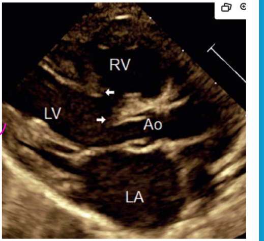 <ul><li><p>Interrupted aortic arch***********</p></li><li><p>Coarctation of the aorta</p></li><li><p>Double outlet left ventricle</p></li></ul><p></p>