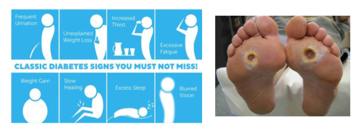 <ul><li><p>other symptoms</p><ul><li><p>blurred vision</p></li><li><p>lethargy</p></li><li><p>nausea</p></li><li><p>vomiting</p></li><li><p>abdominal pain</p></li></ul></li><li><p>Long term health effects </p><ul><li><p>loss of vision</p></li><li><p>kidney failure</p></li><li><p>hypertension</p></li><li><p>cardiovascular problems</p></li><li><p>damage to extremities in the body</p></li></ul></li></ul><p></p>