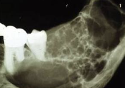 <p>Radiographic Shape : multiple single-chambered lesions that are somewhat fused together, making up the entire lesion; sometimes described as resembling soap bubbles </p>