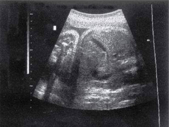 <p>May be difficult to visualize after 32 weeks of gestation; it is thought that it contracts, releasing bile, as a result of initiation of gallbladder function; appears as anechoic structure on right side of fetal abdomen</p>
