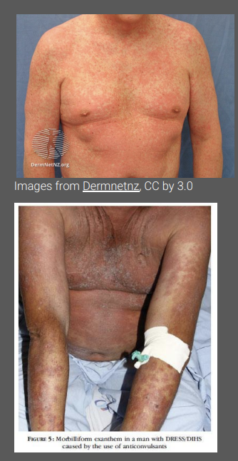 <p>Systemic symptoms (high fever) present followed by the development of a rash </p><p>Morbilliform presentation but targetoid lesions, blisters and pustules may be present </p><p>Erythroderma or exfoliative dermatitis may follow in some patients </p><p>Facial swelling or mucosal involvement (lips, mouth, throat, genitalia) in some </p><p>Multiple organ involvement (e.g.lymph nodes, blood, liver, lung, GI, kidneys, neurological system, heart)</p>