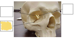 <p>Anterior View of Orbit</p>