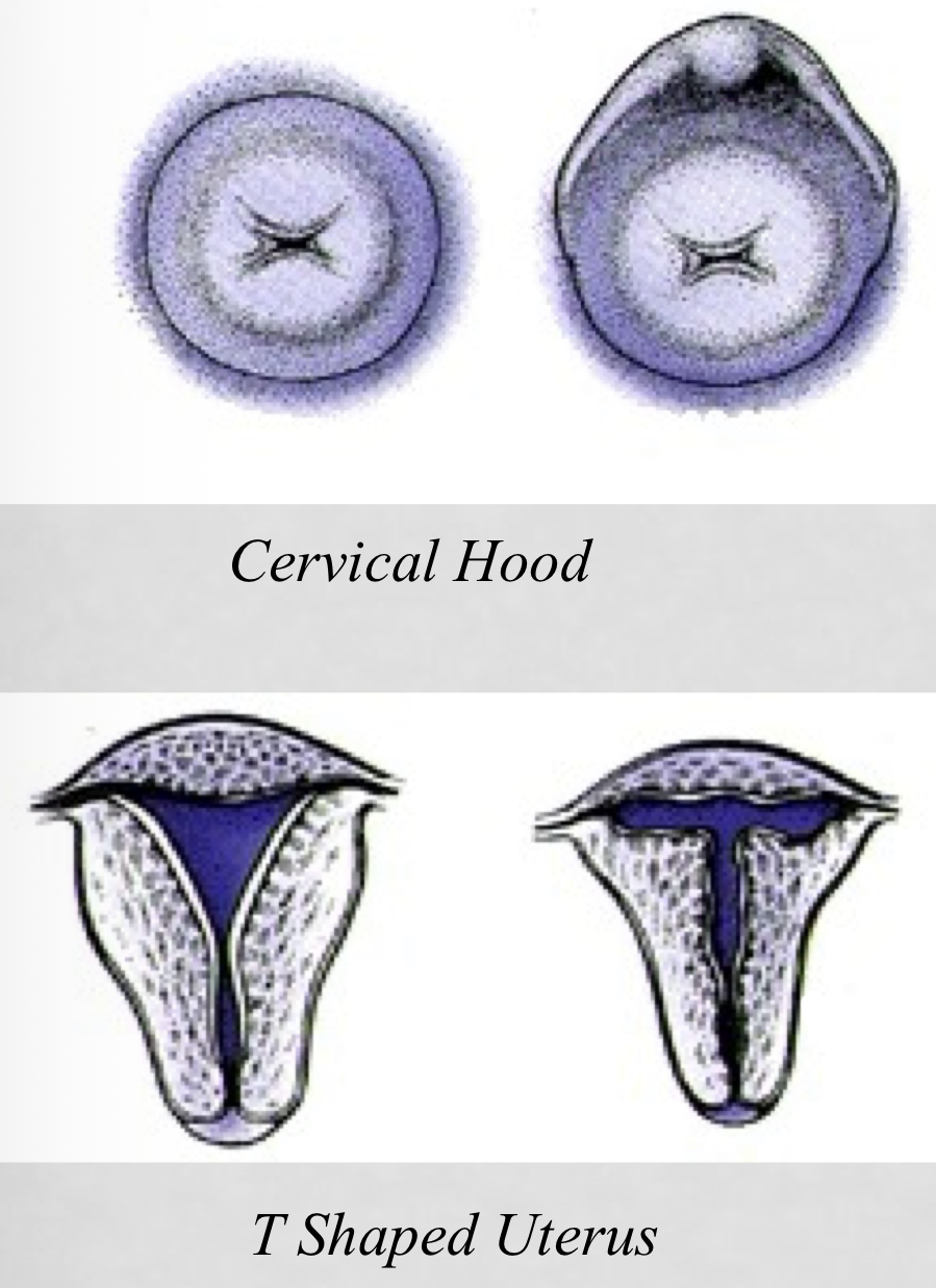 <p>DES was used prior to 1971 to prevent abortion, miscarriage, and premature labor by preventing full expansion of the uterus. Since the uterus wouldn’t fully expand, it would limit/prevent complete fetal development.</p>