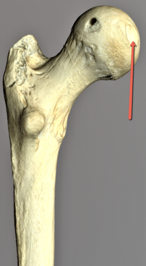 <p><strong>Identify the bone marking indicated by the pointer.</strong></p>