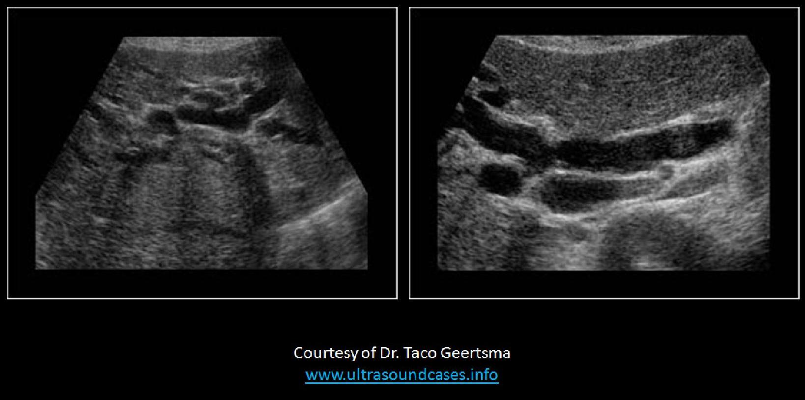 <p>What lab values would be elevated in this patient?</p>