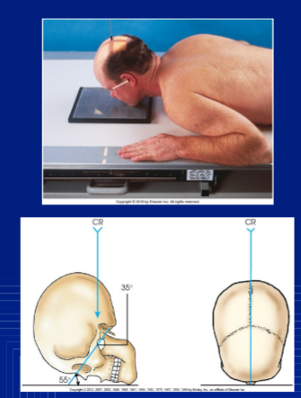 <p>pat pos of MOD WATERS FACIAL BONES</p>