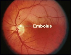 <p>transient ischemic attack of the retina</p>