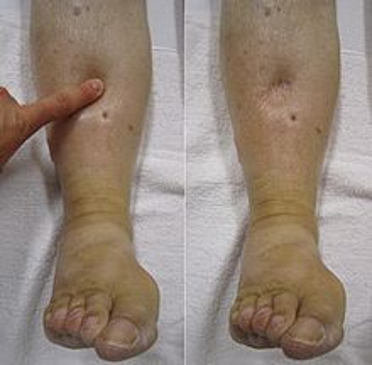<p>excessive amount of fluid in the interstitial compartment, which causes swelling, or enlargement of tissues.</p>