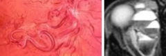 <p>3 Ocular Findings of Wyburn Mason Syndrome</p>