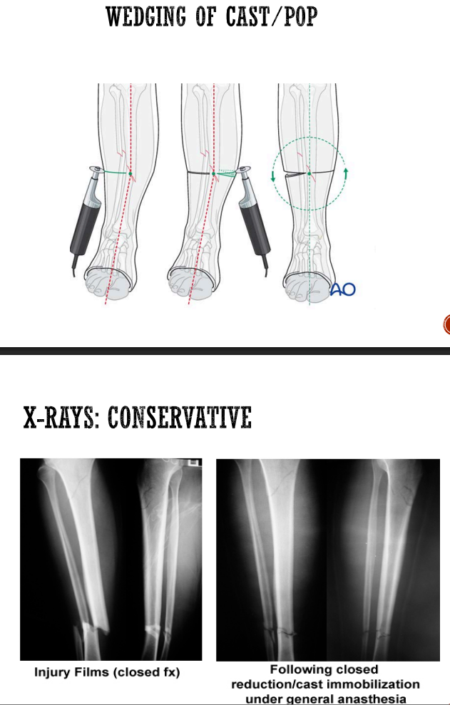 <p>Conservative management:</p><ul><li><p>closed #’s</p></li><li><p>AKPOP with ankle in plantar grade for 6 weeks</p></li><li><p>wedging of POP possible to correct residual tilt</p></li><li><p>calcaneal skeletal traction → when skin viability compromised + massive oedema</p></li><li><p>once reduction achieved + soft tissue viable → traction converted to POP</p></li></ul><p></p><p>Surgical management:</p><ul><li><p>exo-fix </p><ul><li><p>when reduction unlikely to be maintained by POP</p></li><li><p>compound # (grade 3B)</p></li><li><p>risk of infection + debridement of wound</p></li></ul></li><li><p>ORIF</p><ul><li><p>intramedullary nail of shaft of tibia</p></li><li><p>plate + screws</p></li><li><p>fibula refuced w plate + screw if articular involvment</p></li></ul></li></ul><p></p>