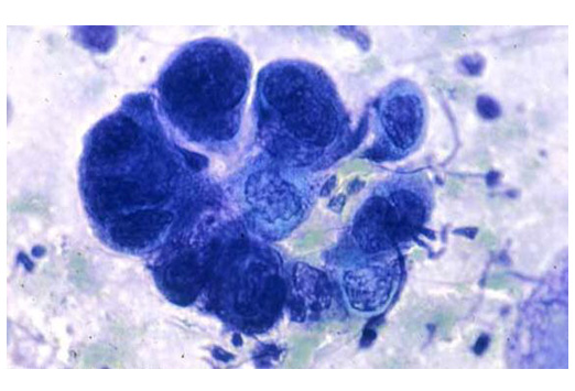 <p>A diagnostic test used to identify HSV infections by examining fluid from vesicles. </p><ul><li><p>It involves scraping the base of a lesion and staining the sample <strong>to visualise multinucleated giant cells under a microscope. </strong></p></li></ul><p></p>