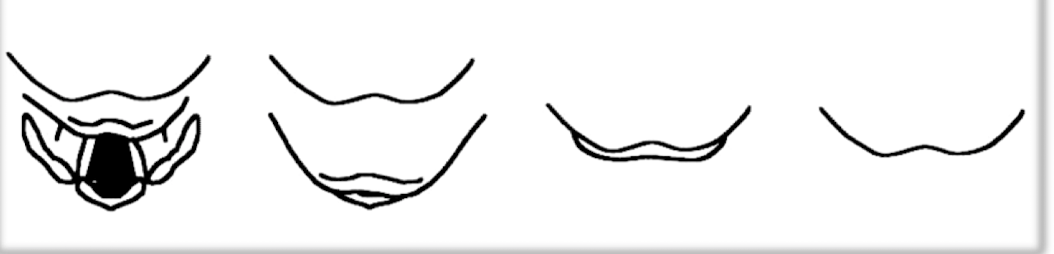 <p>Cormack -Lehane classificaition </p>