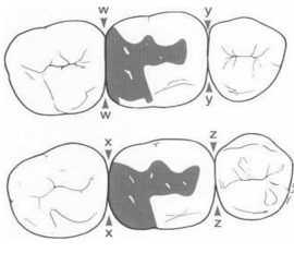 <p>y shows what kind of embrasure form?</p>