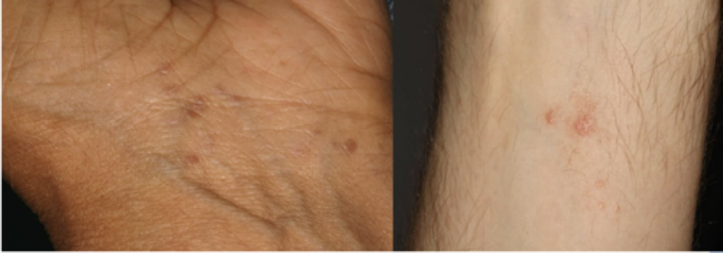 <p>These are clinical features of what condition? </p><p>Skin lesions</p><p>- 1% of population</p><p>- Purple, polygonal, pruritic papules</p><p>- Flexor surfaces of extremities</p>