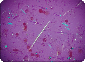 <p>When is the most accurate time to measure the serum urate level in a patient with gout?</p>