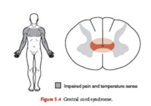 <p>Damage in centre of cervical spinal cord, common moi is hyperextension</p><p>Loss of function in the arms</p><p>Function MAY be preserved in legs and bladder/bowel</p>