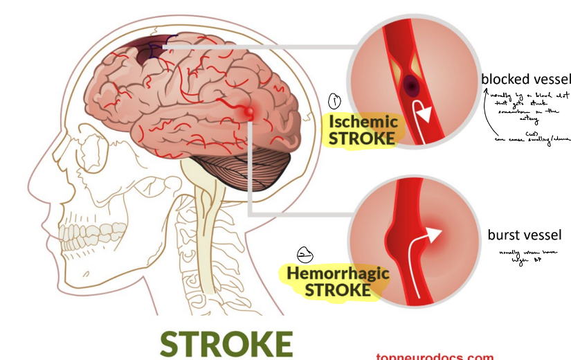 <p><strong><u>stroke</u></strong> — localized<span style="color: rgb(183, 178, 178);">/focal</span> loss of blood flow to the brain due to <u>brain hemorrhage</u> or <u>vessel occlusion/blockage</u></p><ul><li><p>is one of the leading causes of <u>death</u> &amp; <u>long-term disability</u></p></li><li><p>symptoms:</p><ul><li><p><u>numbness or weakness</u> of the face, arm, or leg <strong><u>ESPECIALLY unilaterally</u></strong></p></li><li><p><u>trouble speaking or understanding words</u></p></li><li><p><u>vision problems</u></p></li><li><p><u>loss of balance &amp; coordination</u></p></li><li><p><u>headache </u><strong><u>(more common in hemorrhagic strokes)</u></strong></p></li></ul></li></ul><p><strong><u>infarct</u></strong> — local area with dying or dead cell tissue, b/c lack of blood flow</p><p>__</p><p>loss of blood flow to the brain will deprive the brain of <strong><u>glucose &amp; oxygen</u></strong>, which will form the <u>energy</u> source called <strong><u>ATP</u></strong></p><p>____</p><p><strong><u>ischemic stroke</u></strong> — localized loss of blood flow to the brain due to blocked blood vessel/vessel occlusion</p><ul><li><p>usually due to blood clots that get stuck in the vessel</p></li><li><p>can cause swelling/edema</p><ul><li><p>(b/c <u>decrease of blood flow to the brain means less oxygen and glucose to the brain</u> means <u>less ATP</u> is made, causing the <u>cells in the vessel to have buildup of sodium</u> → dep- → excess glutamate release into synaptic cleft → hyperactivation of NMDARs → excess Na and Ca influx into post- → excess Na brings in water &amp; the <u>cell swells</u>)</p><ul><li><p>^ for buildup of intra- sodium b/c ATP power the Na/K pump to move sodium out of the cell</p></li></ul></li></ul></li></ul><p><strong><u>hemorrhagic stroke</u></strong> — localized loss of blood flow to the brain due to burst blood vessel</p><ul><li><p>usually due to high BP</p></li></ul><p></p>