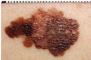 <p>lead to melanomas (skin cancer) </p><p>ABC </p><ul><li><p>A - asymmetry </p></li><li><p>B - border </p></li><li><p>C - colour</p></li></ul><p></p>