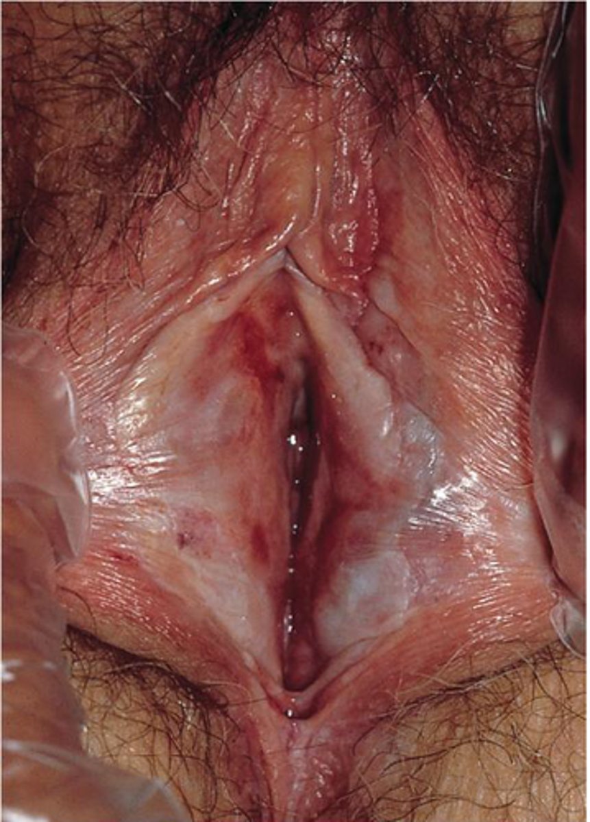 <p>- most common nonneoplastic epithelial vulvar disorder</p><p>- intense pruritus, vulvar skin is thin, wrinkled, and white, with areas of lichenification and hyperkeratosis. Anterior labia minora sides agglutinate, erosions, fissures, ulcerates result from scratching. inability to retract skin around clitoris or labia, women >60</p><p>-biopsy required- thin, hyperkeratosis layer, thinning epithelial layer, plattening papillae, homogenization of stroma, and deep lymphocytic infiltration.</p><p>- Tx: vulvar hygiene, oral antihistamine @ bedtime. Steroid cream (dermovate) BID and PRN lifelong</p>