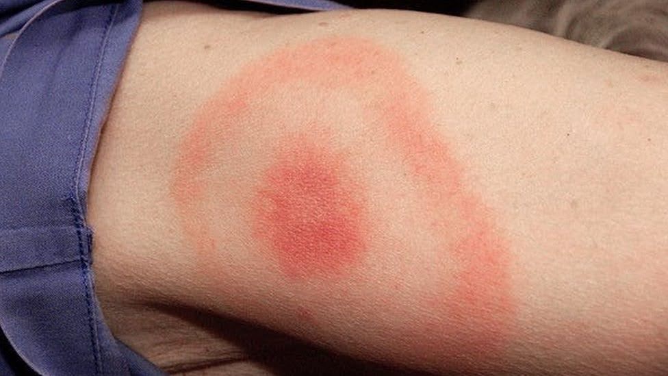 <p>Symptoms of Lyme</p>