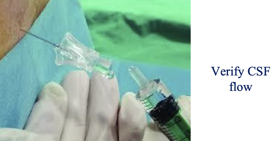 <p>advance the spinal needle through the introducer using the dominant hand, feel for a "pop" as it pierces the ligamentum flavum and dura mater, remove the stylet only, and verify a steady flow of 2-3 drops of CSF</p>