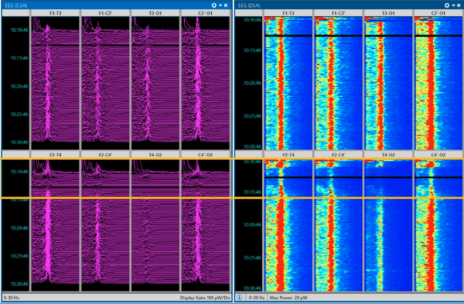 <p>In CSA and DSA EEG, we can see (slowing/speeding up) during clamping that returns when the shunt is in place. </p>