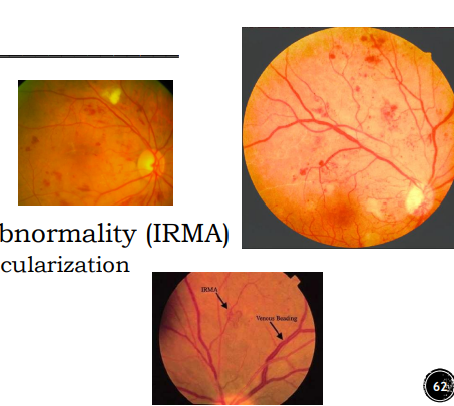 <ul><li><p>Micro-aneurysm</p></li><li><p>Dot and blot hemorrhage</p></li><li><p>Cotton wool spot</p></li><li><p>Venous beading</p></li><li><p>Intraretinal microvascular abnormality (IRMA)</p></li></ul><p></p>
