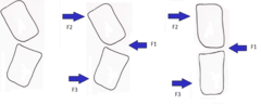 <p>A single force at the area of deformity is counteracted by two additional counter forces in the opposing direction in order to create an immobilization of the deformed segment.</p>