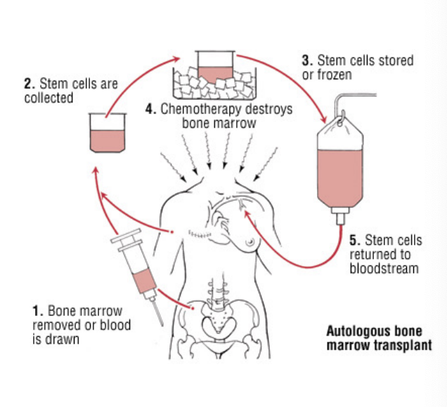 <p>patient’s stem cells are first destroyed by chemotherapy or radiation and then the grafted stem cells restore the functional bone marrow</p>