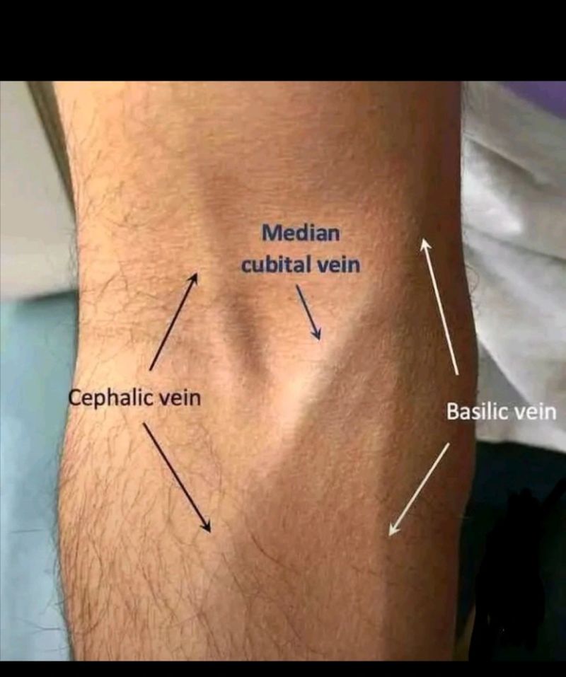 <p>median cubital, basilic, cephalic</p><ul><li><p>if not, dorsal of hand</p></li><li><p>veins should be spongy and bouncy</p></li></ul><p></p>