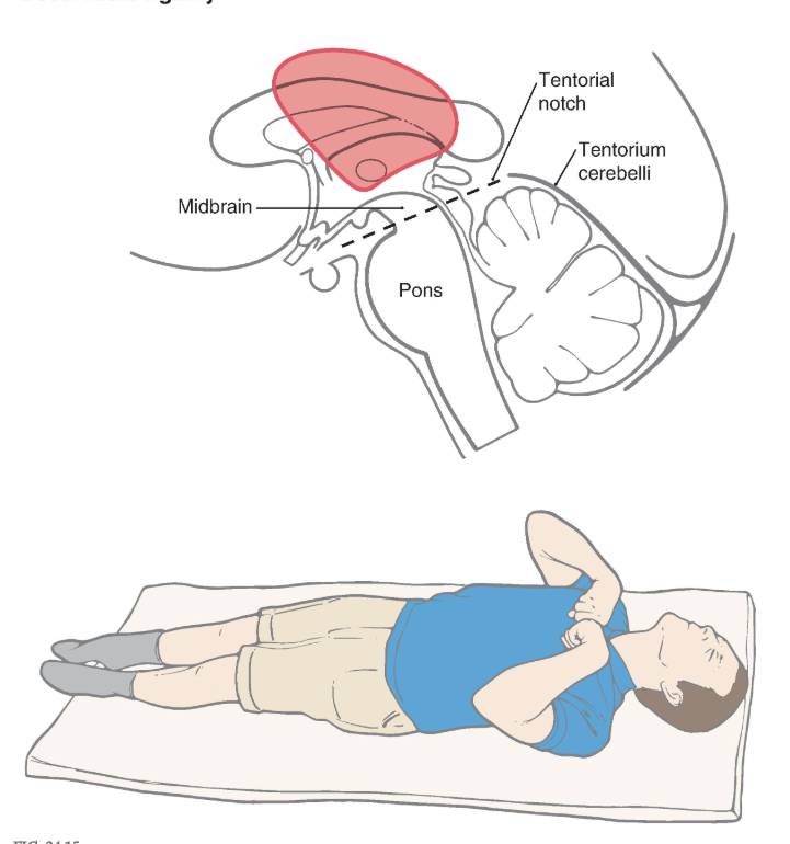 <p>Decorticate rigidity. The lesion is in a supratentorial location. The lower extremities are extended, with the toes pointed slightly inward, and the upper extremities are flexed against the chest. The head is extended. A lesion in the supratentorial location may produce decorticate rigidity or posturing that may proceed to decerebrate rigidity or posturing as the lesion expands inferiorly (caudally) through the tentorial notch.</p><p></p><p>In experimental animals, this posture can be mimicked by transection of the brainstem (decortication) at a level just <strong>rostral to the superior colliculus </strong>( Figs. 24.9D and 24.10D ). This lesion leaves the rubrospinal tract intact while eliminating the cortical input to the red nucleus. The rubrospinal system can still be activated because excitatory projections to the red nucleus from the cerebellar nuclei are unaffected by the lesion ( Fig. 24.10C ). The rubrospinal tract influences primarily <strong>flexor muscles, </strong>and most of this activity, in humans, is limited to the upper extremity. The upper extremities do not exhibit extensor hypertonus but instead show an increase in flexor tone, presumably due to the intact rubrospinal system. In some patients, the lower extremities might exhibit a minimal level of extensor hypertonus for the same reasons as in decerebration. This characteristic type of posturing is called <strong>decorticate rigidity.</strong></p><p>These two conditions, <strong>decerebration </strong>and <strong>decortication, </strong>are not uncommon ( Figs. 24.12 and 24.15 ), and knowledge of these signs and the underlying brain pathologic process is important in the diagnosis and clinical management of these patients. In some cases, the patient may be comatose and initially exhibit decorticate posturing that subsequently converts to decerebrate posturing. This is an ominous sign, as it suggests that the lesion has continued to progress and now involves more caudal portions of the brainstem. The patient’s cardiovascular and respiratory control centers in the medulla may soon be compromised, necessitating prompt intervention.</p>