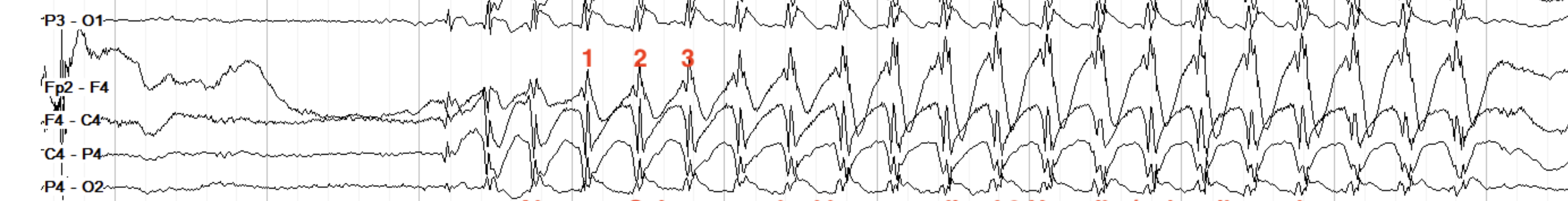 <p>3 hz polyspikes</p>
