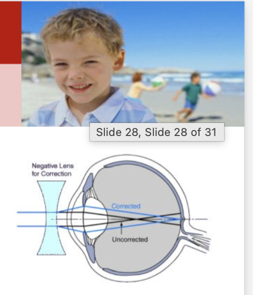 <ul><li><p>Cause- The eyeball is too long or the cornea is too curved → the image focuses in front of the retina</p></li><li><p>Symptoms- faraway objects look blurry</p></li><li><p>Concave lenses or glasses expand the focal length OR laser surgery to change the shape of the cornea or lens</p></li></ul><p></p>