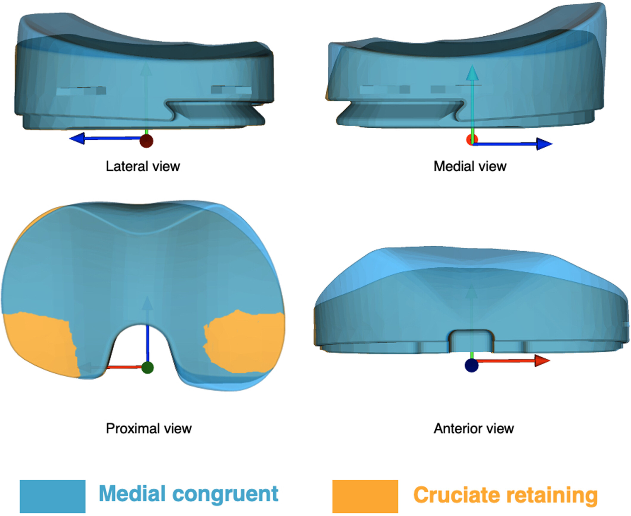 <p>Provisional polyethylene insert (medial congruent) trialed on the tibia to set stability.</p>