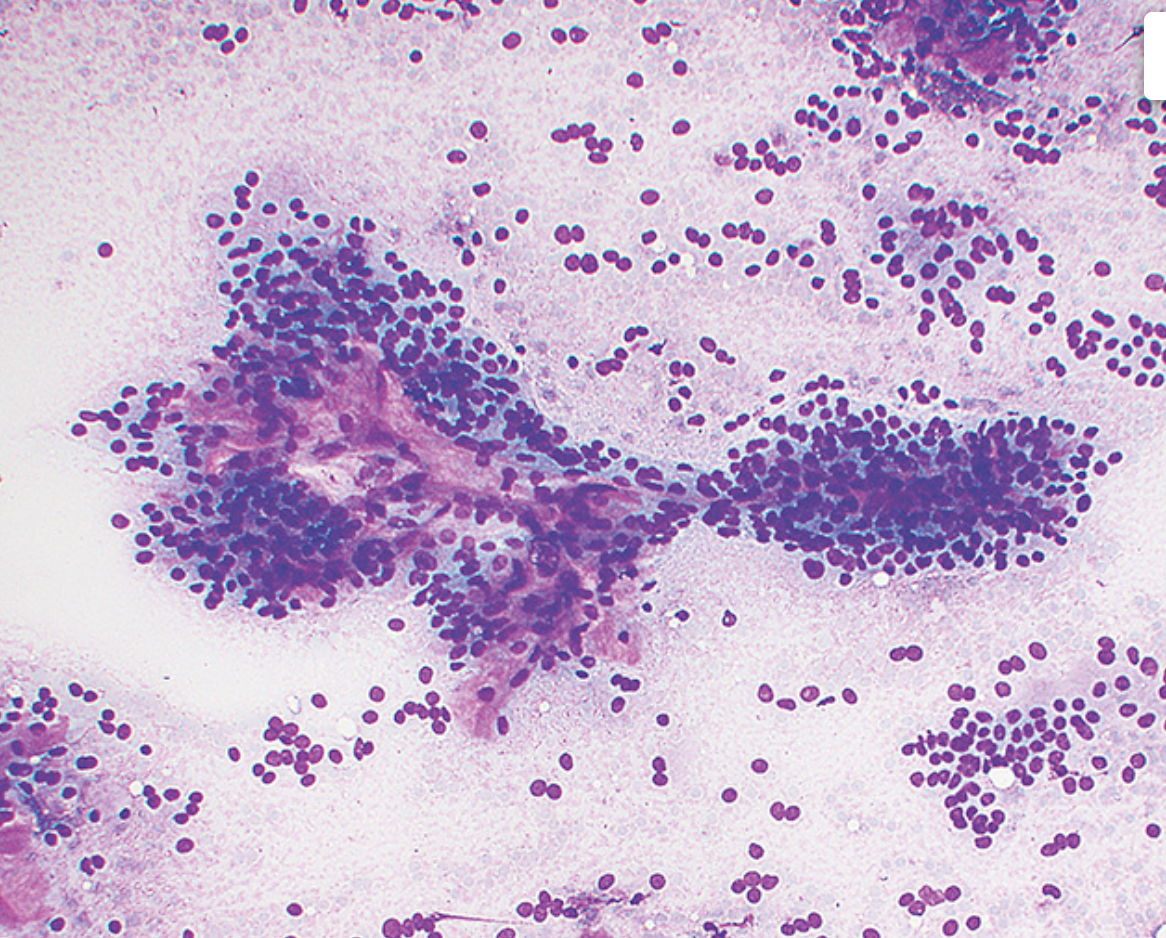 <p>Cytologie salivaire (glandes mineures)</p><p>1) Catégorie selon Milan</p><p>2) Diagnostic</p>