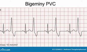 <p>(premature ventricular contractions) </p><ul><li><p>Also known periodic wide bizarre QRS (ventricular because QRS)</p></li><li><p>Bizarre -> tachycardia (- you can call a group of PVC’s a short run of V-tach)</p></li></ul><p></p>