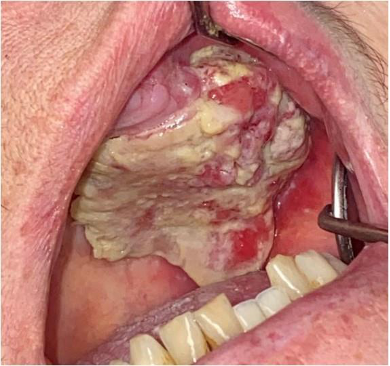<p>CASE: A patient has a persistent ulcerative, destructive lesion of the palate. Biopsy shows squamous cell carcinoma. Which site-specific lecture entity is this?</p>