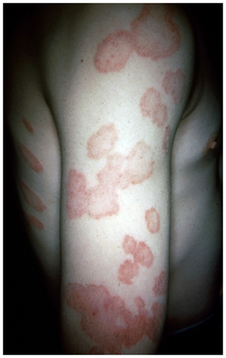 <p>Causative Agent: Dermatophytic Molds, Yeasts, etc.</p>