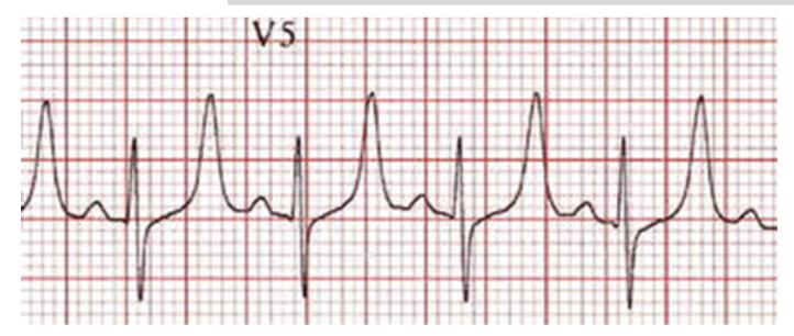 <ul><li><p><span style="background-color: transparent; font-family: "Times New Roman", serif;">Peaked T waves can be result of hyperkalemia</span></p><ul><li><p><span style="background-color: transparent; font-family: "Times New Roman", serif;"><em>Too much k+ → high her he K+ then higher the waves </em></span></p></li></ul></li></ul><p></p>