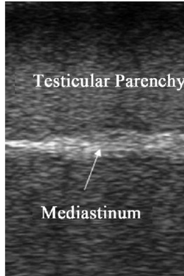 <p>Mediastinum</p>
