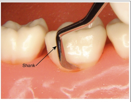 <p>When the shank of the instrument is parallel to the long axis of the tooth.</p>