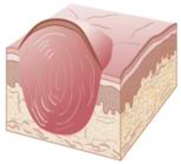 <p>no pathological reactions</p><p>solid elevation <span style="color: red;"><strong>0.5-1cm</strong></span> in diameter</p><p>larger than papules, <span style="color: red;">deep seated in submucosa</span></p>