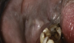 <ol start="43"><li><p>Identify the finding shown.</p></li></ol><p></p>
