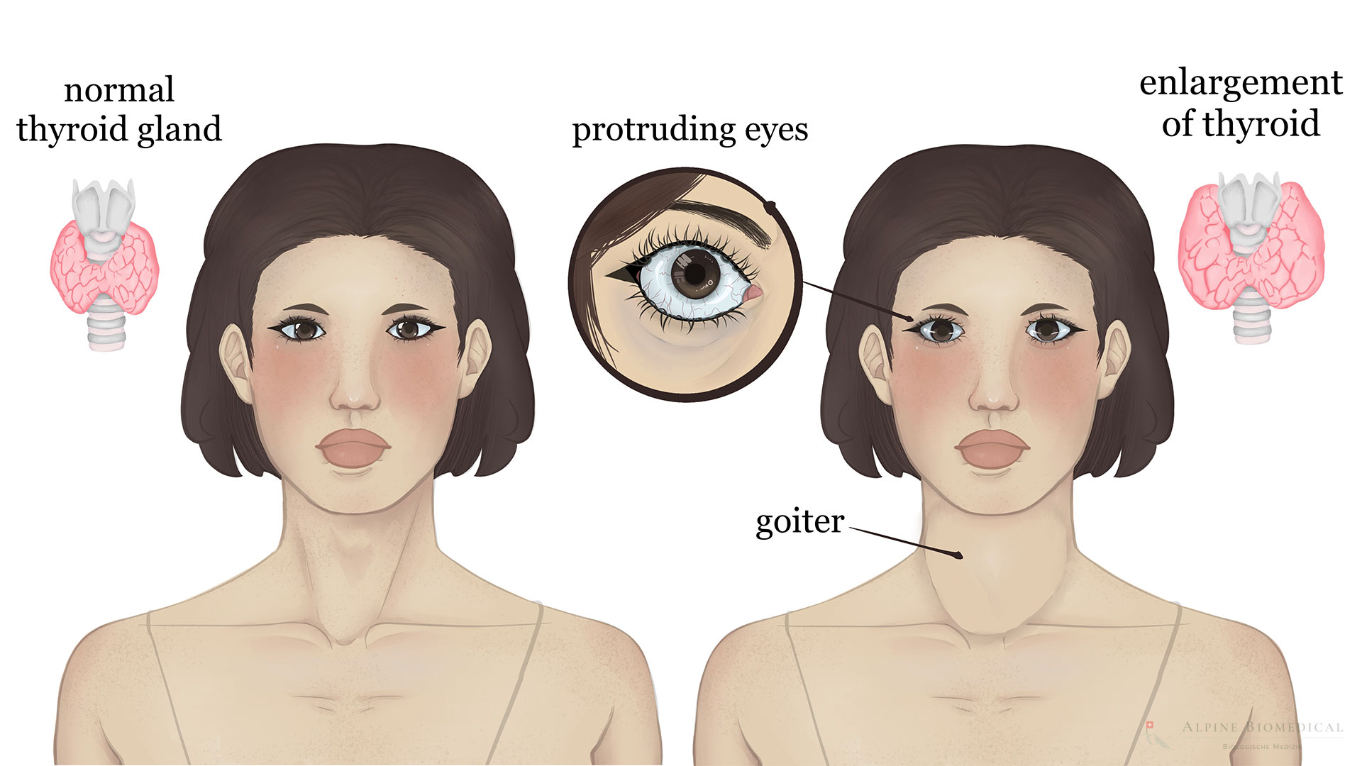 <p>hyperthyroidism (definition, S/S, treatment)</p>