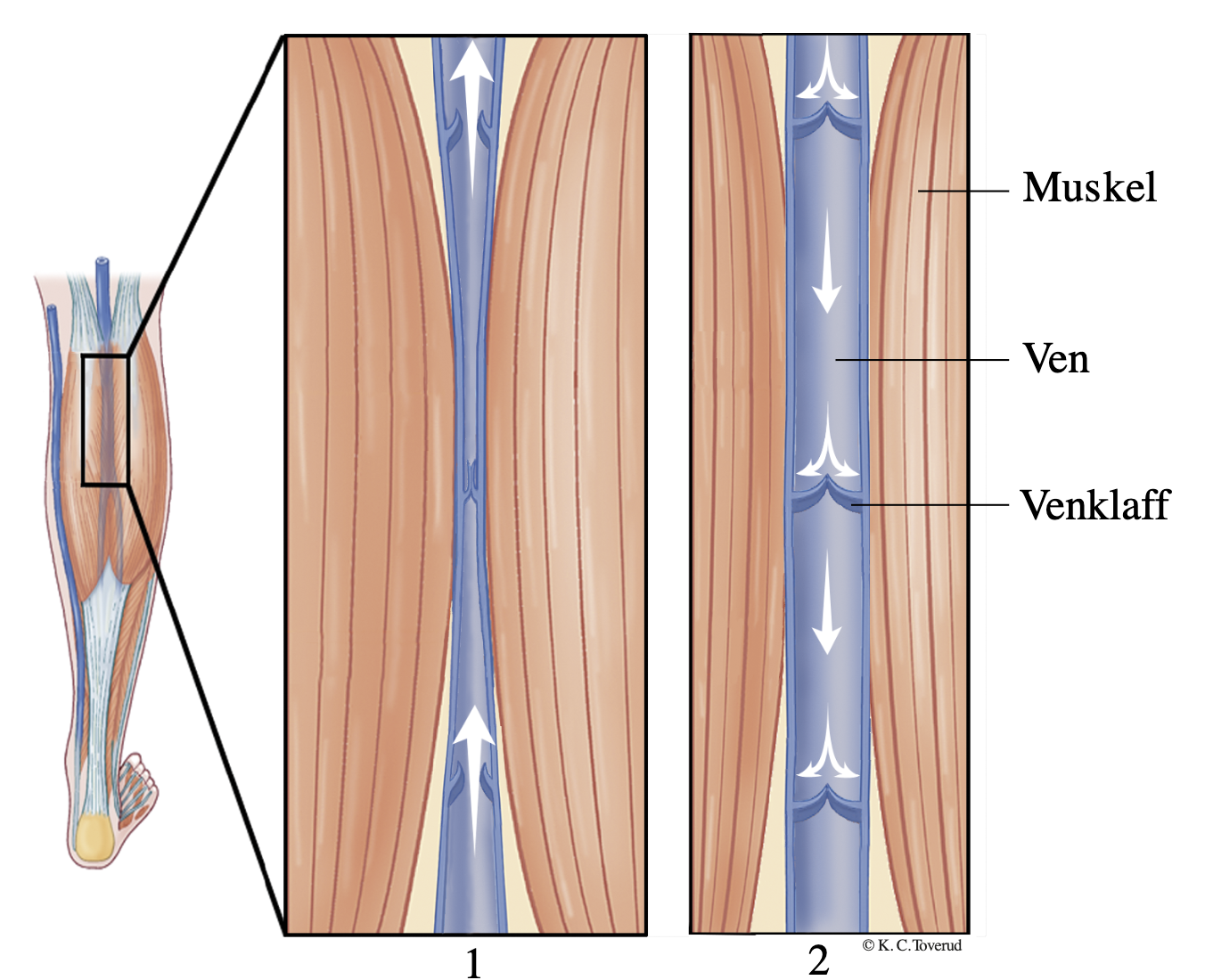 <p><span style="background-color: transparent; font-family: "Cormorant Garamond", serif;"><strong><mark data-color="#f0e0ff" style="background-color: rgb(240, 224, 255); color: inherit;">Vener</mark>: </strong>Leder blodet tillbaks in i hjärtat</span></p><ul><li><p><span style="background-color: transparent; font-family: "Cormorant Garamond", serif;">Behöver inte ha lika tjock cellvägg som artärerna eftersom blodtrycket inte är lika högt då blod har flödat ut till kroppen.</span></p></li><li><p>=> trycket är mycket lågt, och hjärtats slag påverkar inte längre blodet utan det behöver annan hjälp för att ta sig till hjärtat / transportera blodet mot gravitationen:</p><ul><li><p><span style="background-color: transparent; font-family: "Cormorant Garamond", serif;"><strong><mark data-color="#f0e0ff" style="background-color: rgb(240, 224, 255); color: inherit;">Venklaffar</mark></strong> som bara kan öppnas i en riktning där <strong>skelettmusklerna</strong> hjälper till att pressa upp blodet segment för segment via kontraktion av musklerna.&nbsp;</span></p></li><li><p>Det tryck bröstkorgen ger upphov till varje gång man andas</p></li></ul></li></ul><p></p>