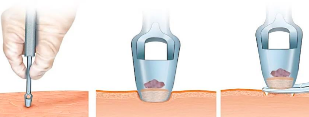 <p>removal of a small piece of tissue using a punch (a small, hollow <span style="color: red;">cylindrical tube-like bladed instrument)</span></p>