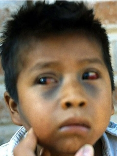 <p>Caused by <strong>Bordetella pertussis</strong></p><p><strong>Whooping cough (pertussis) is transmitted through respiratory droplets</strong>.</p><p>Most important <strong>exotoxin immobilizes cilia</strong></p><p>More severe in small children</p><p></p><ul><li><p><strong>Catarrhal stage:</strong></p></li></ul><p>Buildup of excessive discharge in respiratory tract</p><p>Most contagious stage</p><ul><li><p><strong>Paroxysmal stage:</strong></p></li></ul><p>Dead cells and mucus accumulation over 2–4-week period</p><p>Labored breathing</p><p>Spasmodic coughing due to paralyzed cilia; can’t eliminate mucus</p><p>Rapid-firing coughs in one exhalation followed by high-pitched whoop.</p><p>This is due to forced inhalation over a<strong> partially closed glottis.</strong></p><ul><li><p><strong>Convalescent stage:</strong></p></li></ul><p>Persistent coughing decreases</p><p>Treated with antibiotics</p><p>Prevented by DTaP</p><p></p><p>Increasing due to:</p><p>Not getting vaccinated</p><p>Immunity declines of time</p><p>Evolution of resistant strains</p>