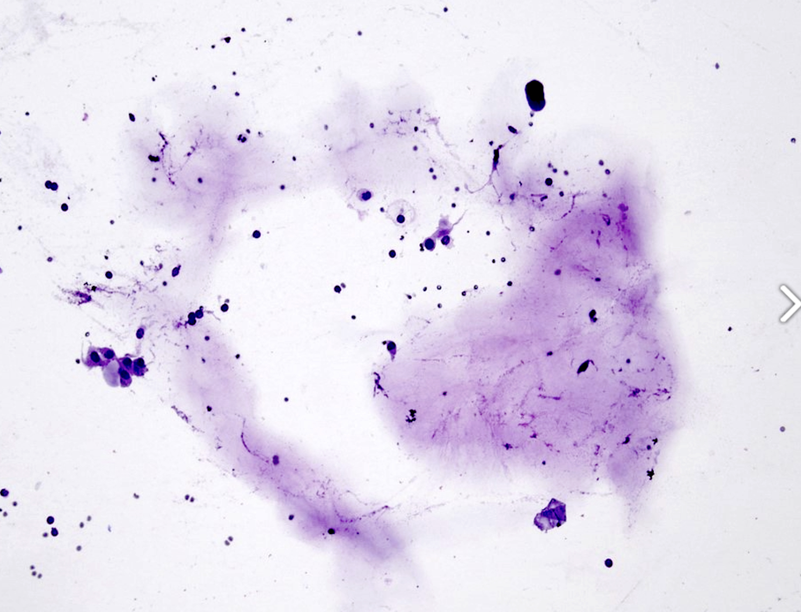 <p>Cytologie glande salivaire </p><p>1) Catégorie</p><p>2) Diagnostique possible évoquant cette catégorie</p>