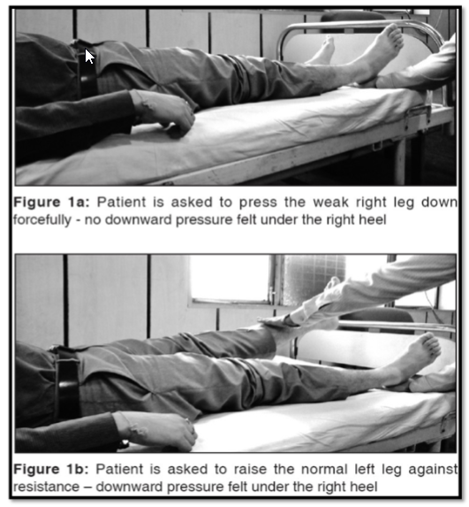 <p></p><p><br></p><p><span style="background-color: transparent;">Procedure:</span></p><ul><li><p><span style="background-color: transparent;">Exammer places hand under heel of weak leg and asks the patient to press the heel down forcefully. It appears weak but when the opposite hip is flexed against resistance, downward pressure will be felt under the heel of weak leg</span></p></li></ul><p><br></p><ul><li><p><span style="background-color: transparent;">Discrepancy between voluntary hip extension (which is weak) and involuntary hip extension (which is normal) when the opposite hip is being flexed against resistance suggests functional paresis.</span></p></li></ul><ul><li><p><span style="background-color: transparent;">Hoover sign is thought to be due to crossed extensor reflex to stabilize the trunk/body</span></p></li></ul><p></p>